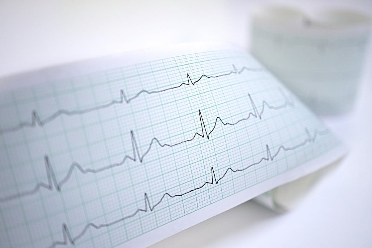 ECG report